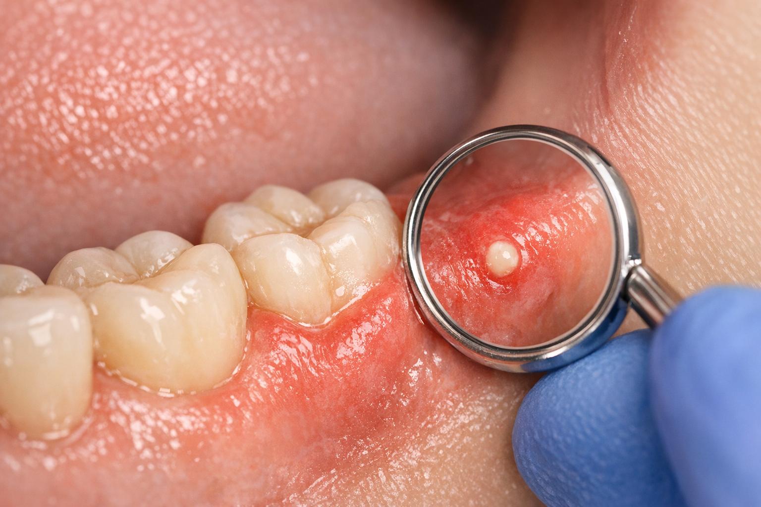 Geschwollenes Zahnfleisch: Abszess, Entzündung, Weisheitszahn